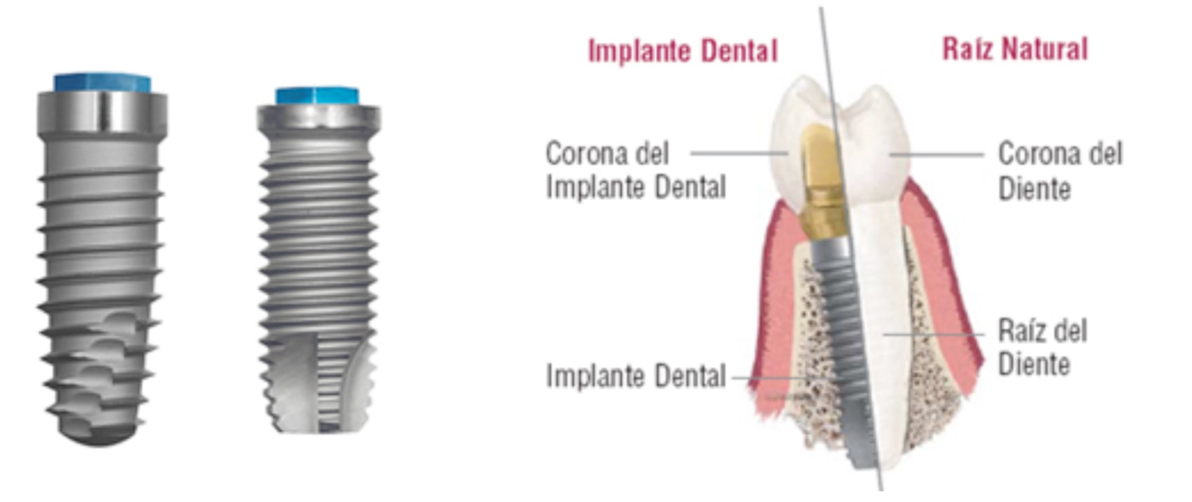 Esquema de Implantes