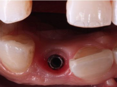 programa de implantes dentales Clinica de encias