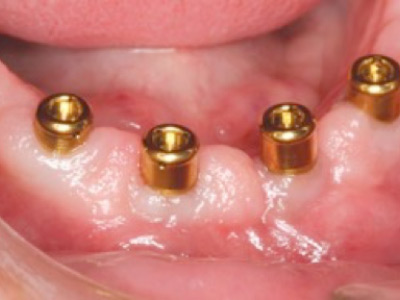 implantes dentales Clinica de encias
