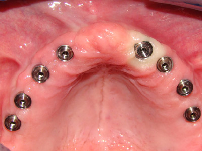 Prótesis Híbrida Fija con 8 implantes con Carga Inmediata