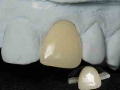 implantes dentales GU