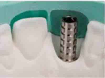 Clinica de encias viña del Mar y quillota implantes dentales