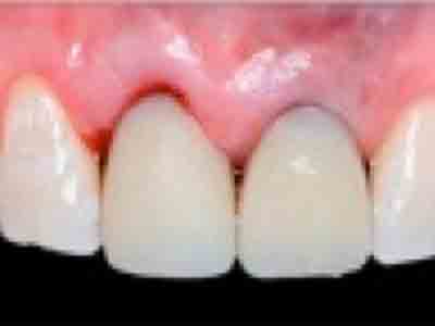 Foto tratamiento de implantes con provisorio en boca