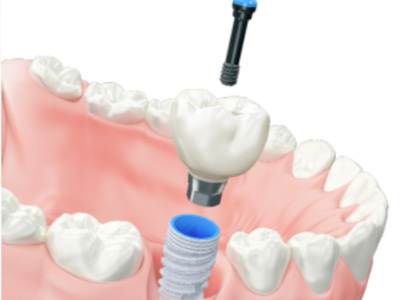 tratamiento de implantes dentales implante unico sin provisorio 01